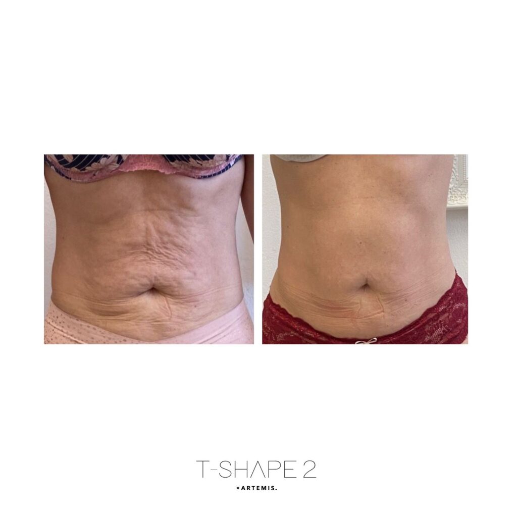T-Shape 2 abdomen before and after