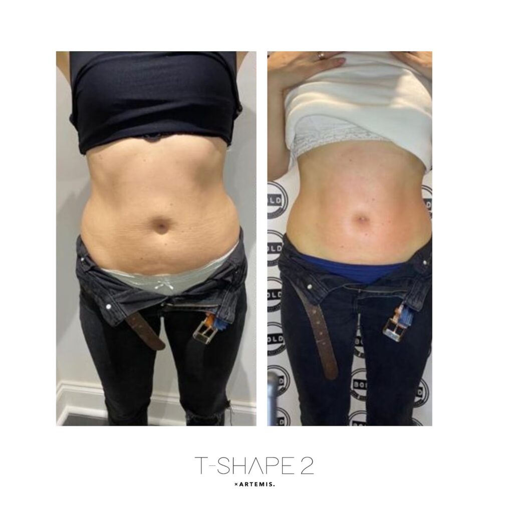 T-Shape 2 abdomen before and after