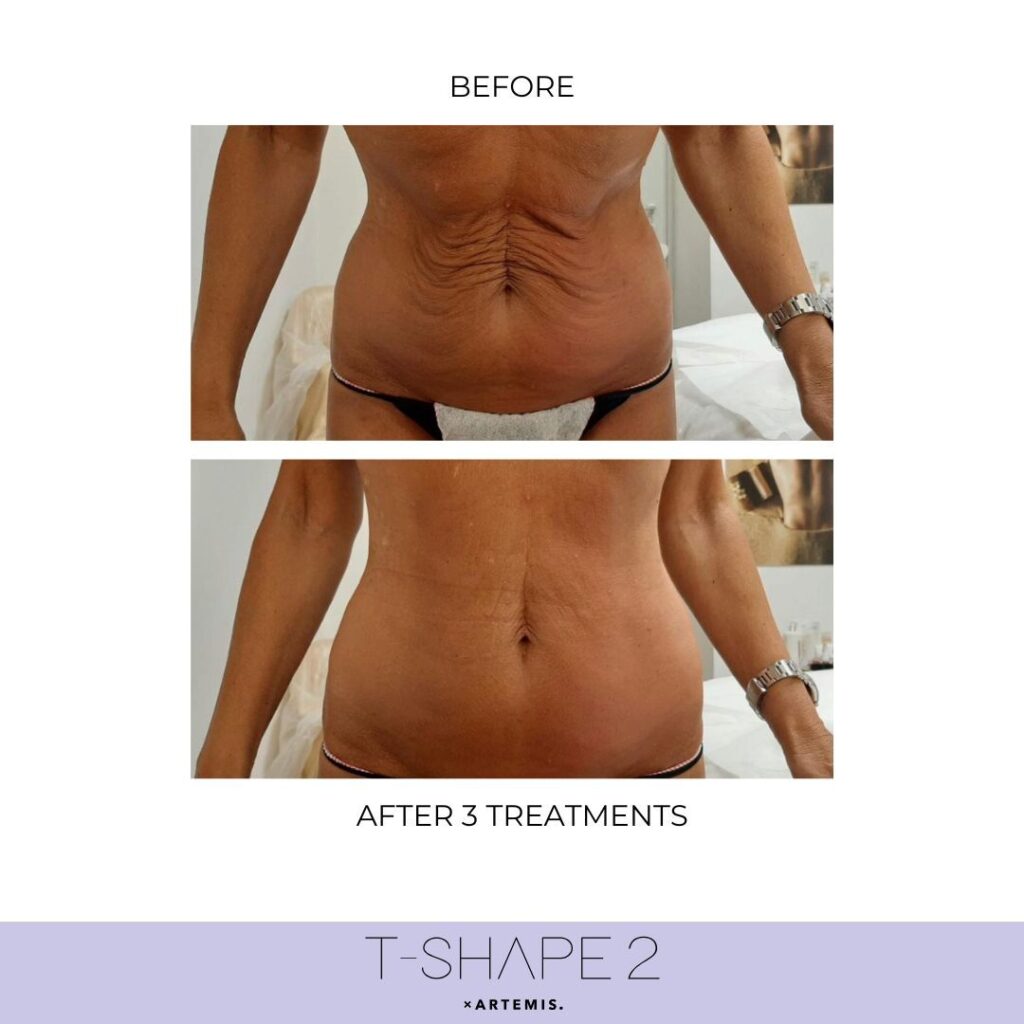T-Shape 2 abdomen after three treatments