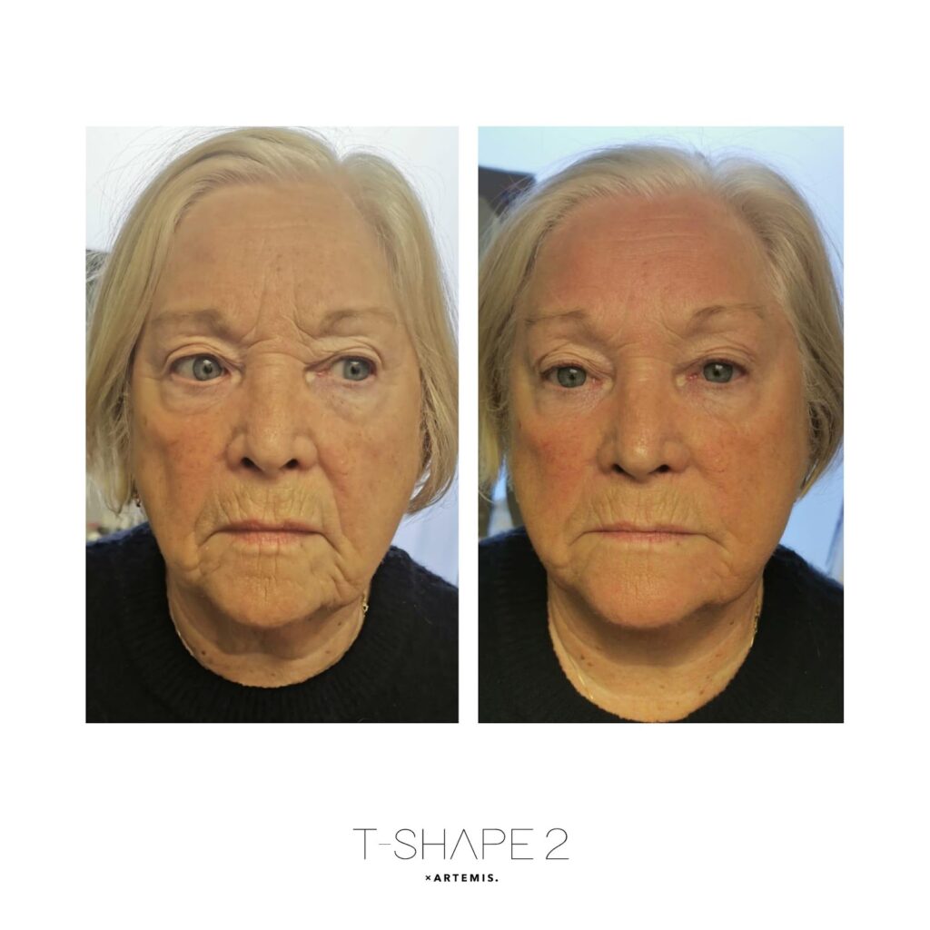 T-Shape 2 after one treatment