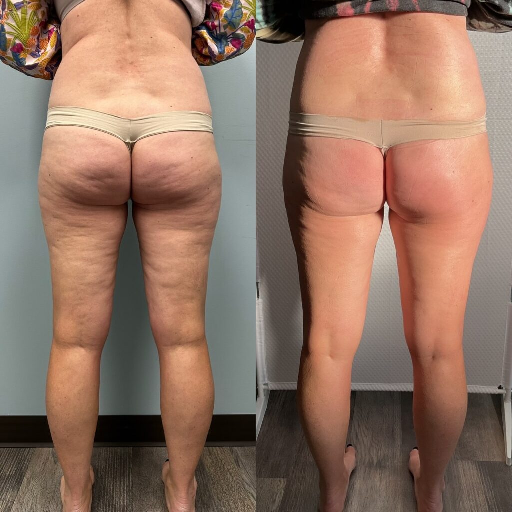 T-Shape 2 back after three treatments