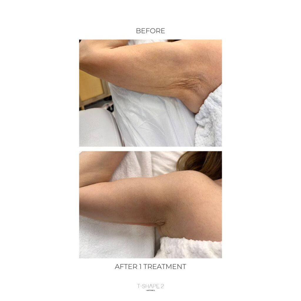 T-Shape 2 arms after one treatment