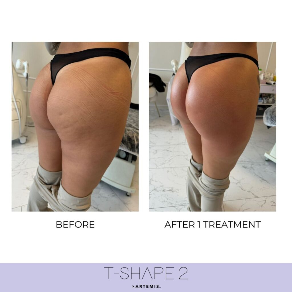 T-Shape 2 before and after example 1