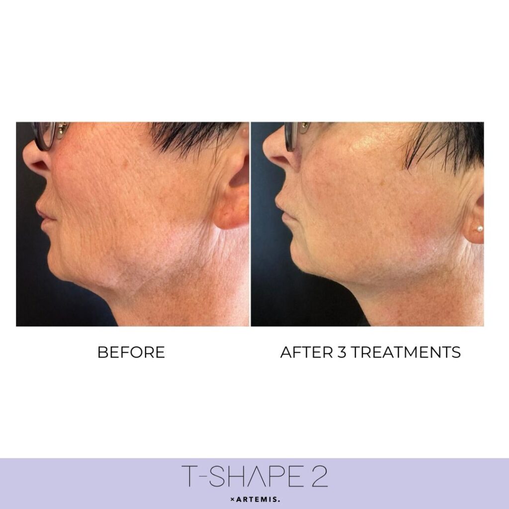 T-Shape 2 before and after example 2
