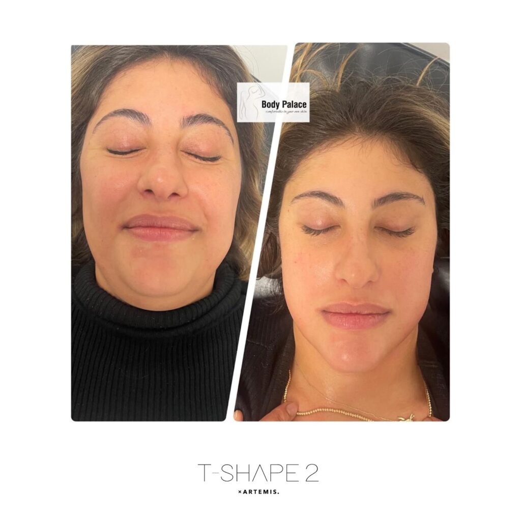 T-Shape 2 face before and after