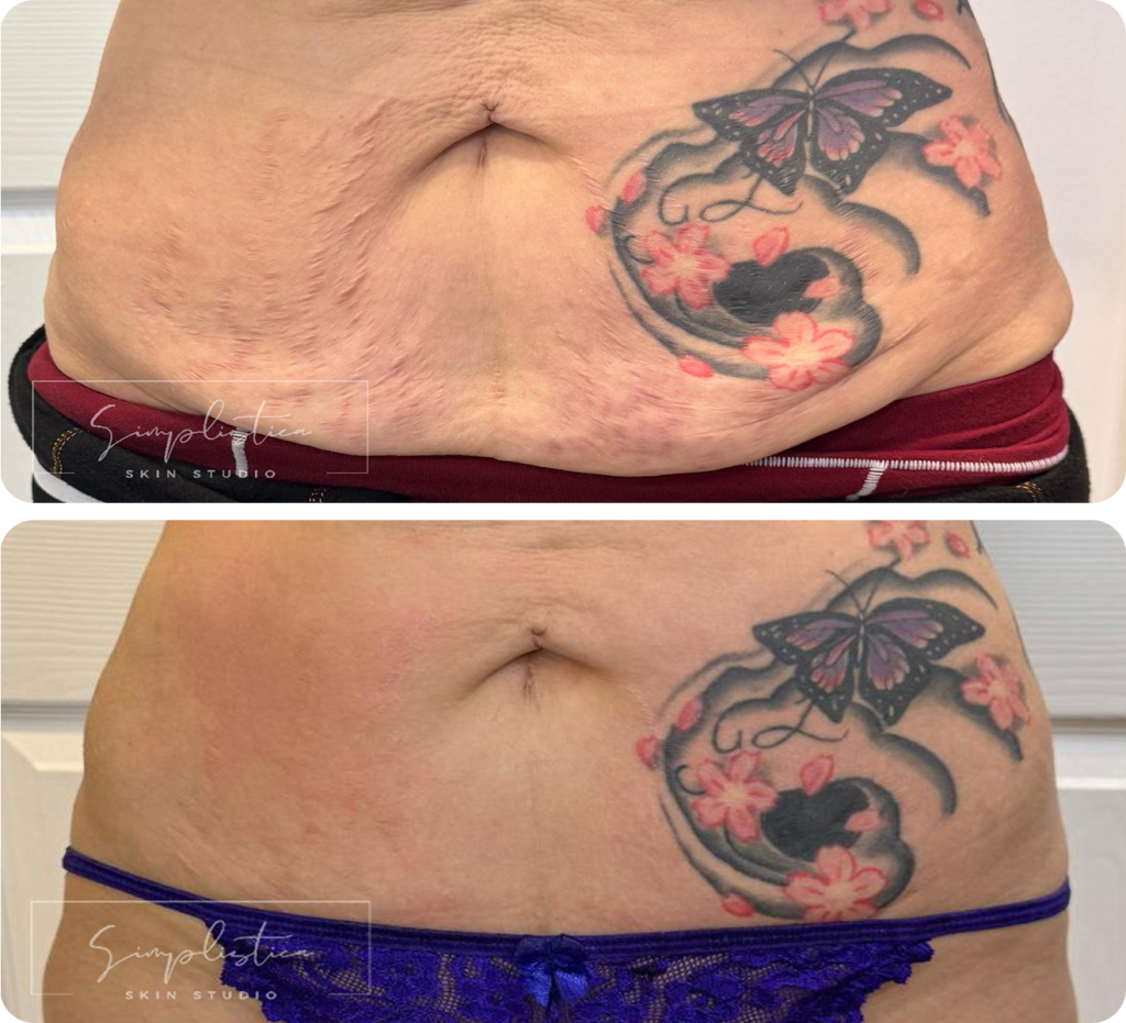 T-Shape 2 after five treatments